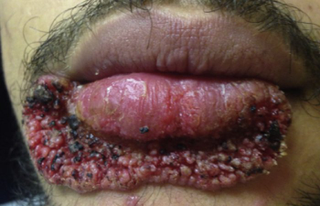 Resultado de la infección. Journal of Emergency Medicine